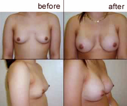 breast augmentation pictures. Breast Augmentation Insanity